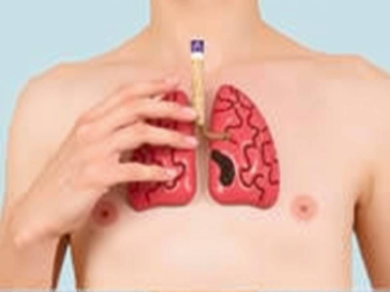 Do Lymph Nodes Swell When You Quit Smoking?(1)