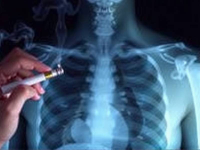 Why Getting a Chest X-Ray Helps Quit Smoking
